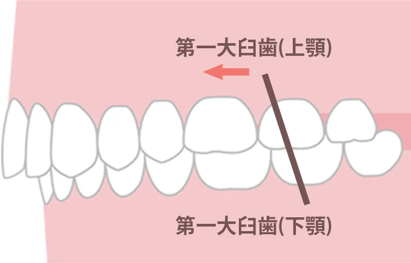 顎なし・口元の突出が気になる方