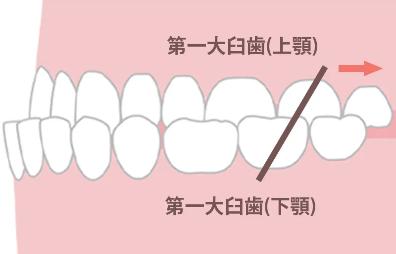 受け口・しゃくれが気になる方